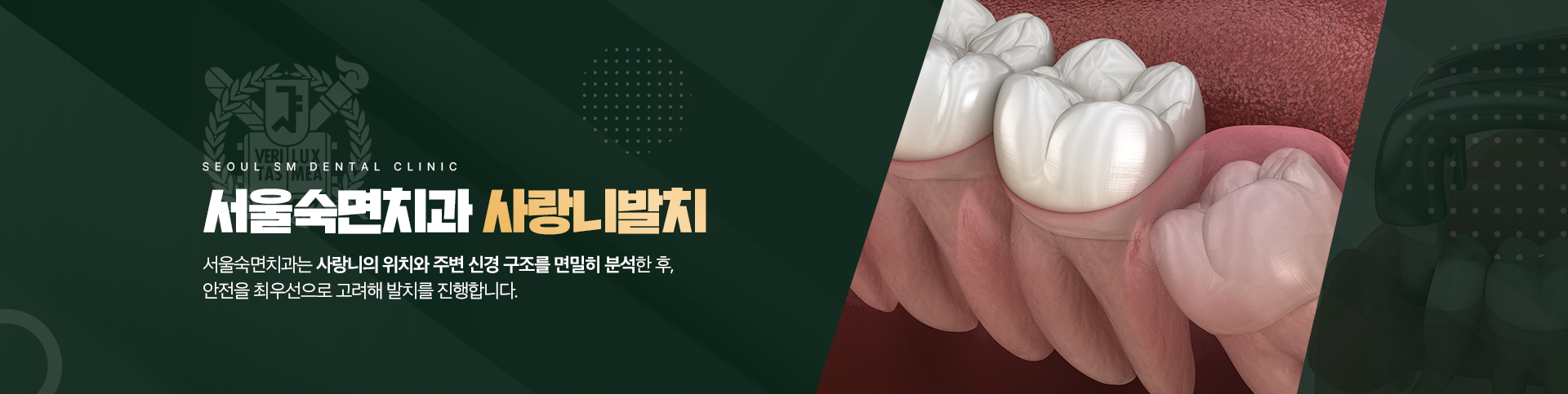 서울숙면치과 사랑니발치-서울숙면치과는 사랑니의 위치와 주변 신경 구조를 면밀히 분석한 후, 안전을 최우선으로 고려해 발치를 진행합니다.